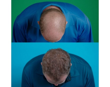 Velform Hair Grow 1+ 1 Grátis